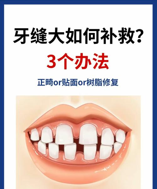 中间牙缝大怎么处理_牙缝大？戴牙套贴面或补牙来矫正