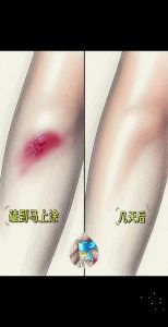 摔了淤青发紫怎么处理_摔伤淤青颜色变？冷敷热敷看时机！