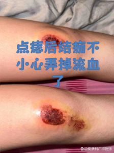 伤口结痂厚硬如何处理_伤口结痂厚硬怎么办？