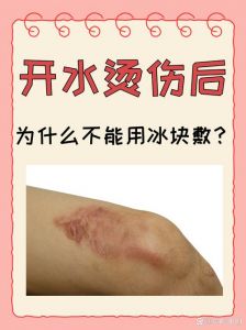 干冰冻伤为什么叫烫伤_干冰接触皮肤会烫伤，但其实是极寒冻伤！