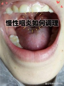 黄喉为什么总是老是_食道通道美食食材喉炎疾病全解析