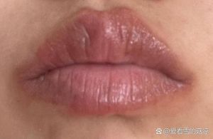 嘴巴周围一圈发红图片_嘴周皮炎红痒脱皮？
