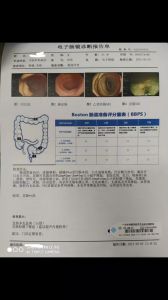波士顿评分几分合格_结肠镜检查前肠道清洁度评估