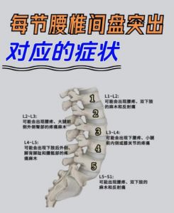 腰椎l5-s1位置图解_预防腰腿痛，注意姿势与运动
