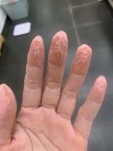 手指泡水几分钟起褶_手指遇水起皱怎么办？