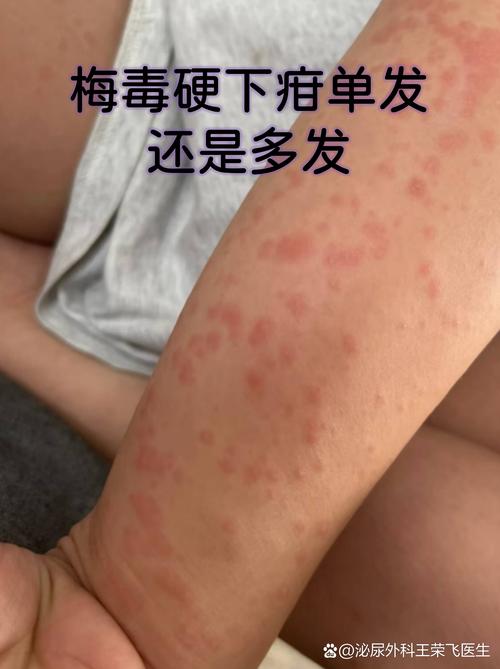 硬下疳最简单辨别方法图片_不痛小疙瘩易忽视