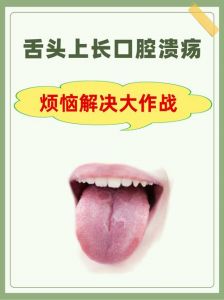 口舌生疮一两天就好的方法_口舌生疮快速缓解方法