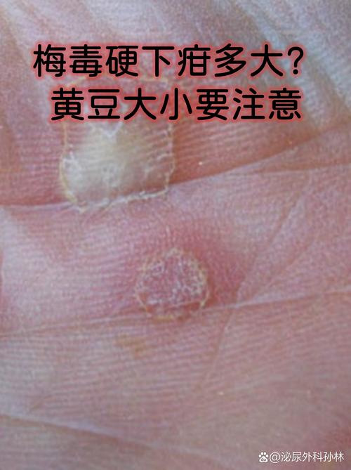 硬下疳最简单辨别方法图片_不痛小疙瘩易忽视