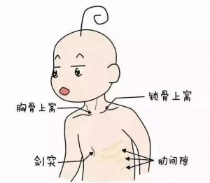 三凹征指哪三个部位图_吸气时胸骨上窝锁骨上窝肋间隙凹陷，是大气道堵塞的求救信号