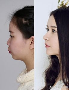自然方法改善嘴凸_化妆按摩呼吸好习惯，严重需专业矫正