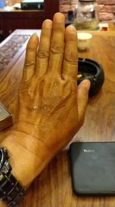 被100度开水烫到手处理方法_冲冷水涂药膏防疤痕