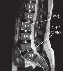 腰5-骶1椎间盘位置图解_腰5骶1椎间盘突出，腰腿疼？