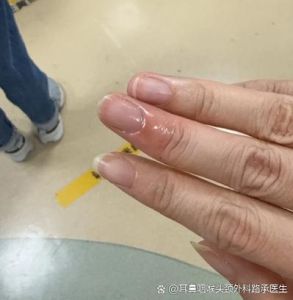 鱼刺扎进手里怎么处理_鱼刺扎手别慌，正确处理远离感染