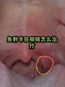 卡鱼刺的正确处理方法_鱼刺卡喉别吞咽，照光夹取快就医