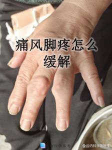 脚痛风的几个部位图_痛风发作痛难忍？及时查尿酸是关键！