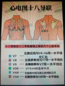 心电图部位6个示意图_电极正确贴放是关键