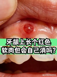 牙龈肉坨戳开无脓的解决方法_牙龈硬肉包发肿？别忽视！改习惯勤护理