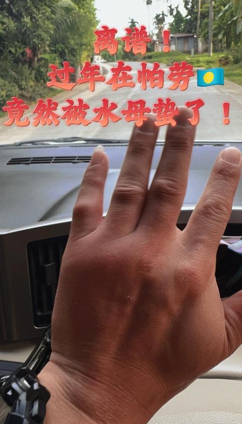 被海蜇蛰了之后会怎样_别用海水，用淡水和明矾