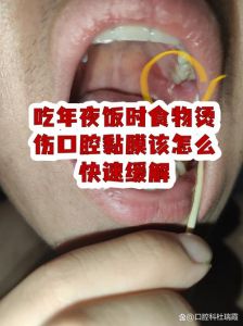 吃热的烫到了口腔上_高温食物烫伤口，冷水漱口忌触碰